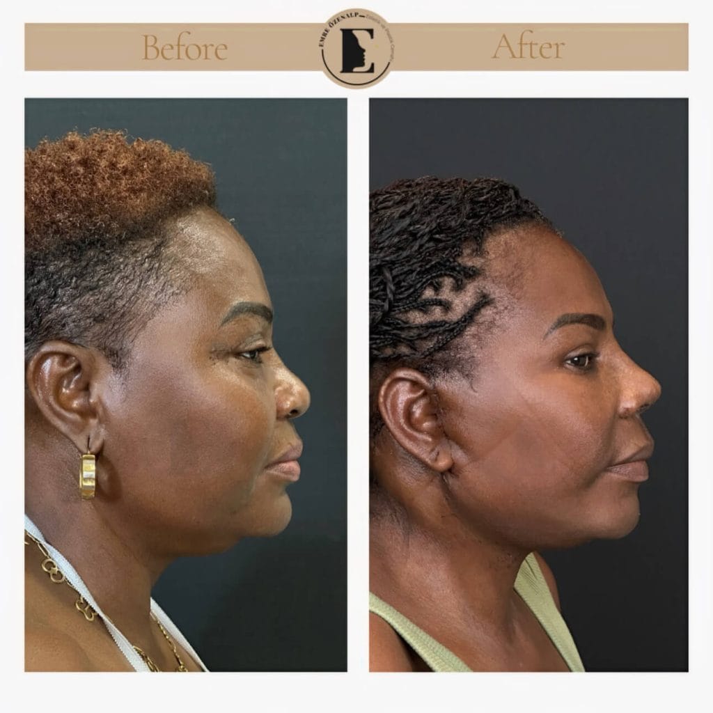 Facelift before after in Turkey results with experienced doctor Emre Özenalp. The patient has been done face lift with neck lift.