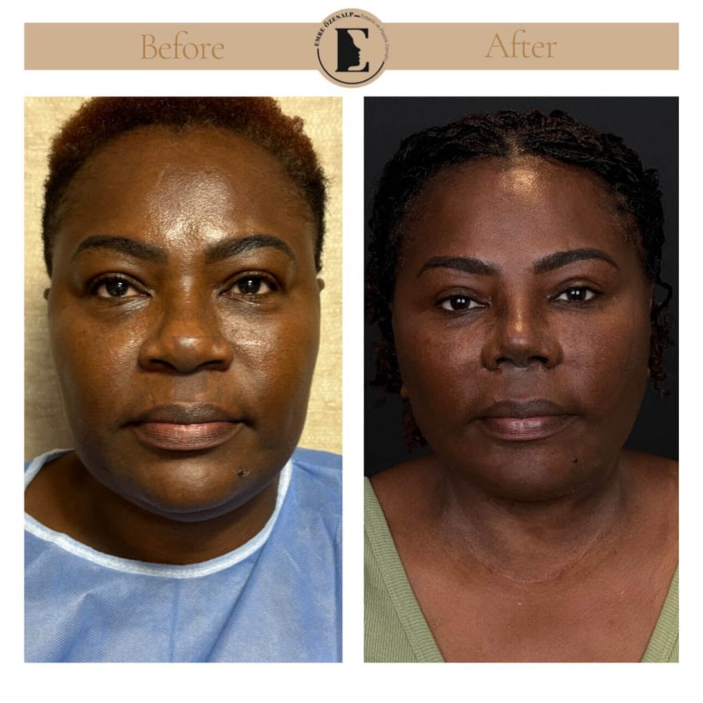 Facelift before after in Turkey results with experienced doctor Emre Özenalp. The patient has been done face lift with neck lift.