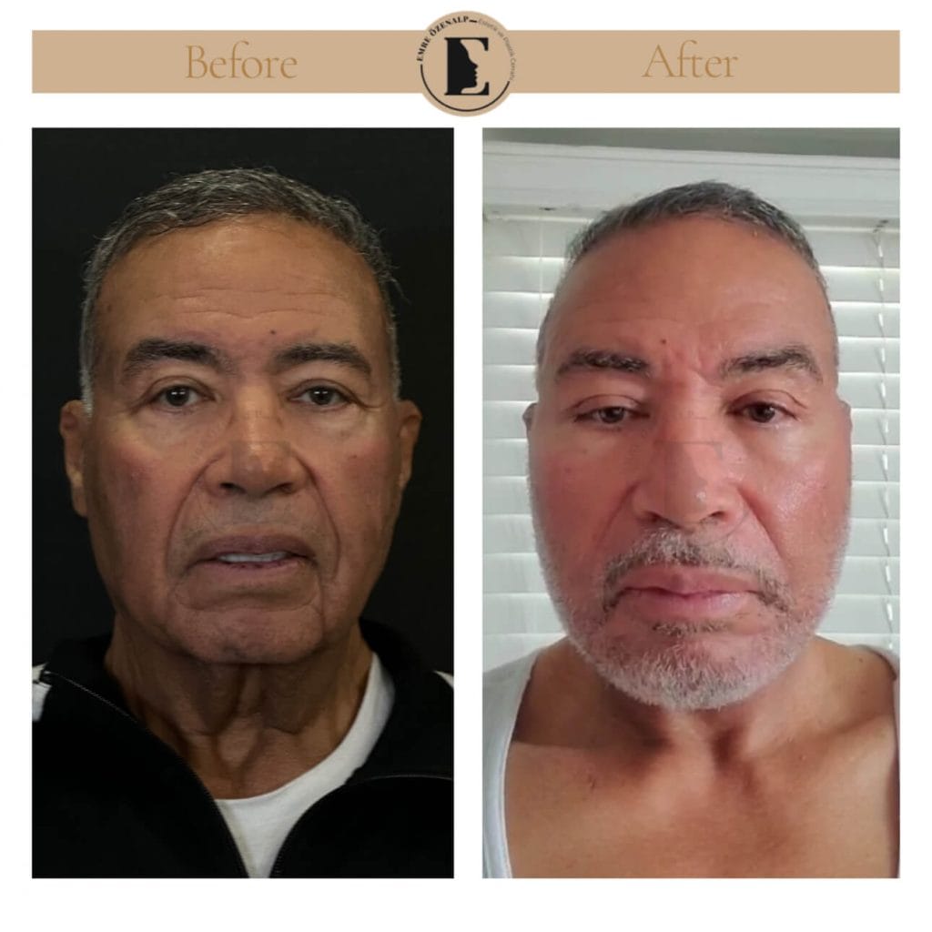 Facelift before after in Turkey results with experienced doctor Emre Özenalp. The patient has been done face lift with neck lift.