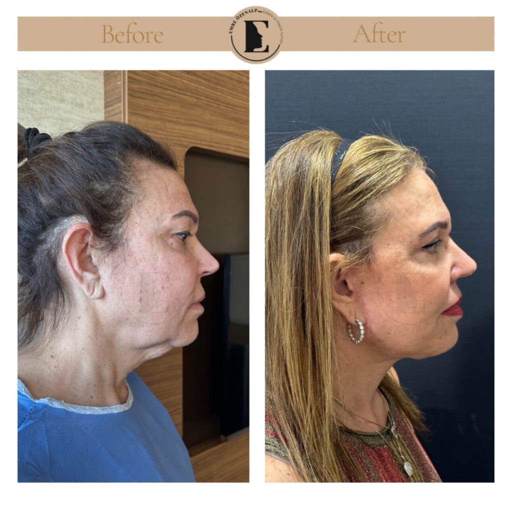 Facelift before after in Turkey results with experienced doctor Emre Özenalp. The patient has been done face lift with neck lift.