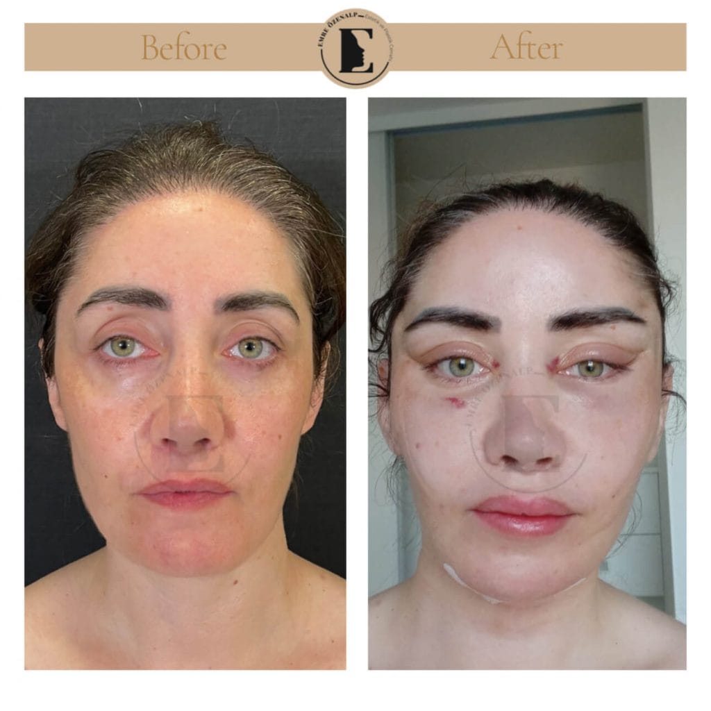 Facelift before after in Turkey results with experienced doctor Emre Özenalp. The patient has been done face lift with neck lift.