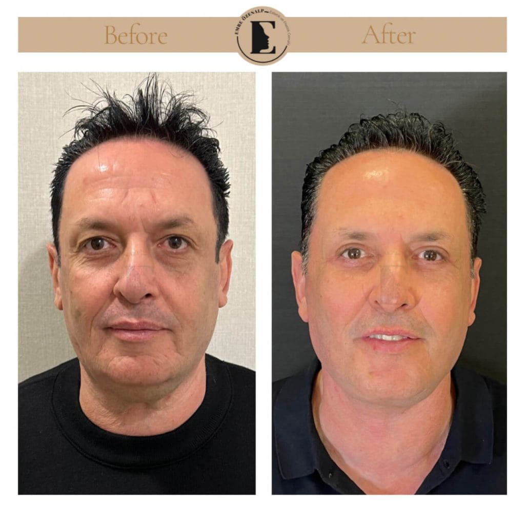 Facelift before after in Turkey results with experienced doctor Emre Özenalp. The patient has been done face lift with neck lift.