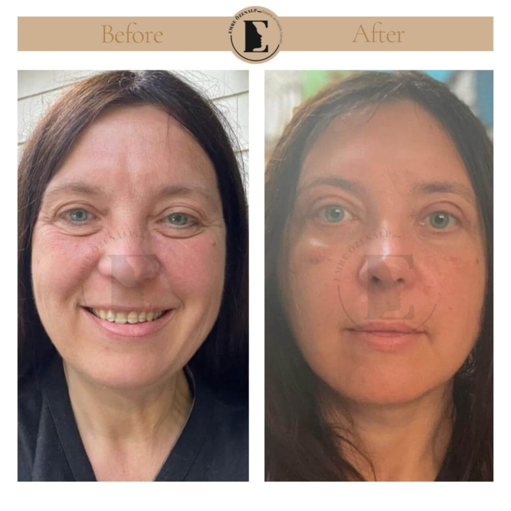 Facelift before after in Turkey results with experienced doctor Emre Özenalp. The patient has been done face lift with neck lift.
