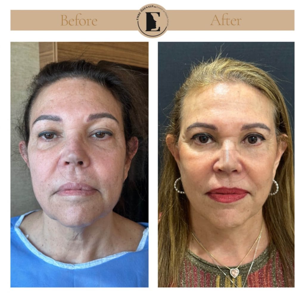 Facelift before after in Turkey results with experienced doctor Emre Özenalp. The patient has been done face lift with neck lift.