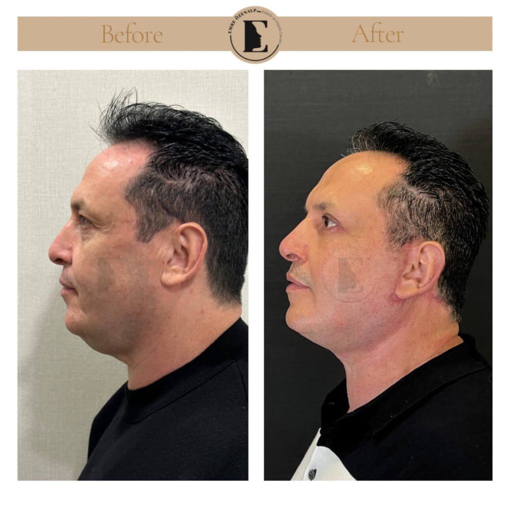 Facelift before after in Turkey results with experienced doctor Emre Özenalp. The patient has been done face lift with neck lift.