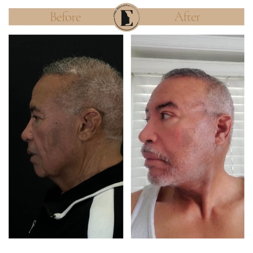 Facelift before after in Turkey results with experienced doctor Emre Özenalp. The patient has been done face lift with neck lift.