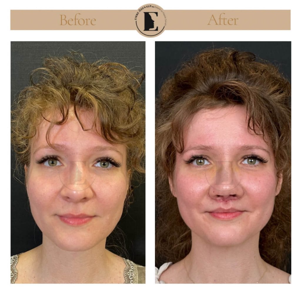 Lip lift surgery before after in Turkey results with experienced doctor Emre Özenalp. The patient has been done upper reshape lip lift surgery