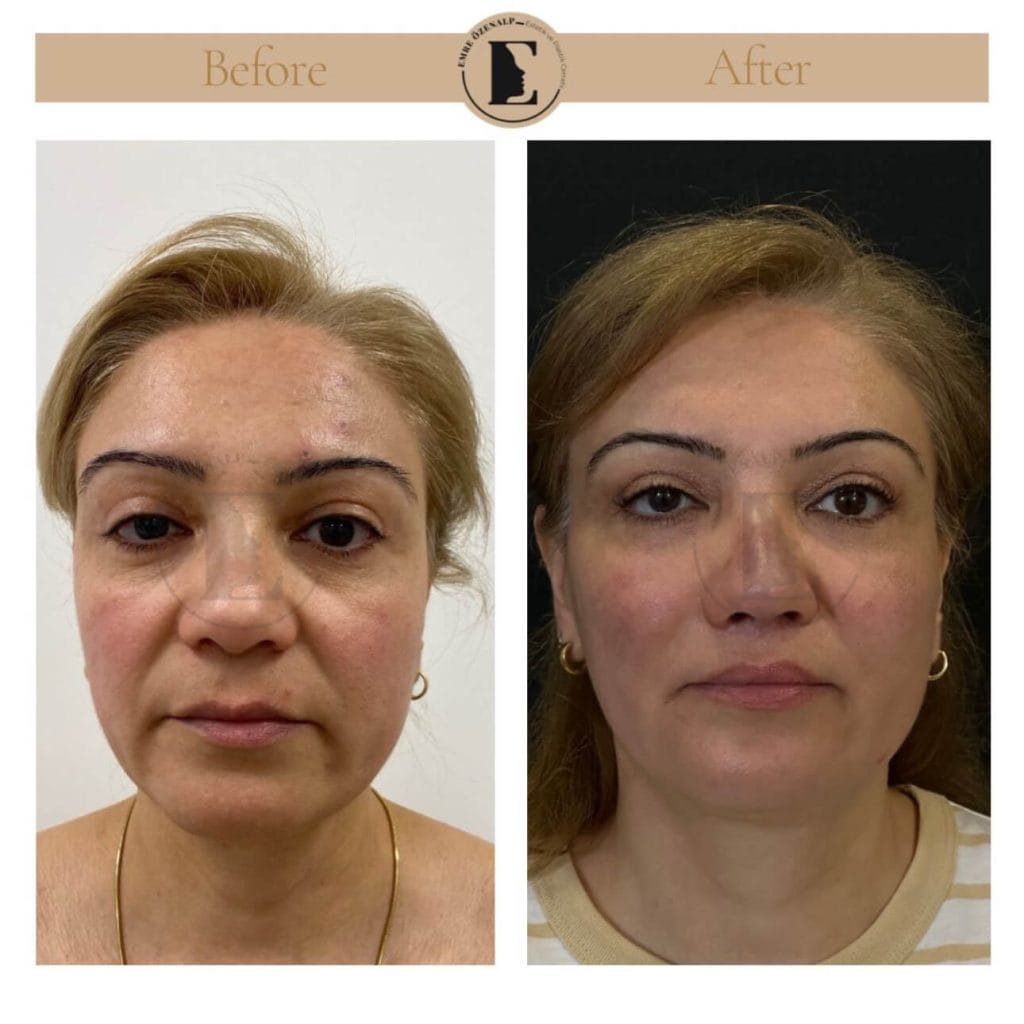 Lip lift surgery before after in Turkey results with experienced doctor Emre Özenalp. The patient has been done upper reshape lip lift surgery