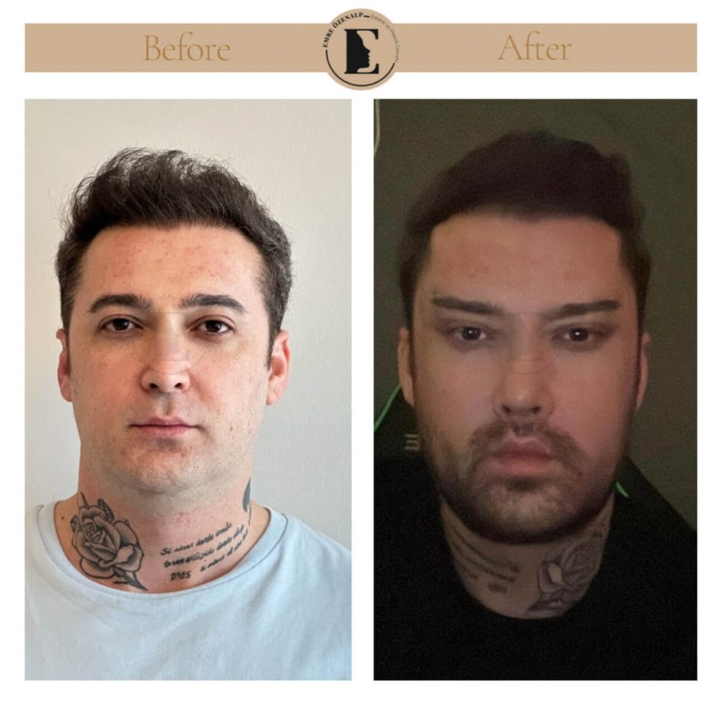Lip lift surgery before after in Turkey results with experienced doctor Emre Özenalp. The patient has been done upper reshape lip lift surgery