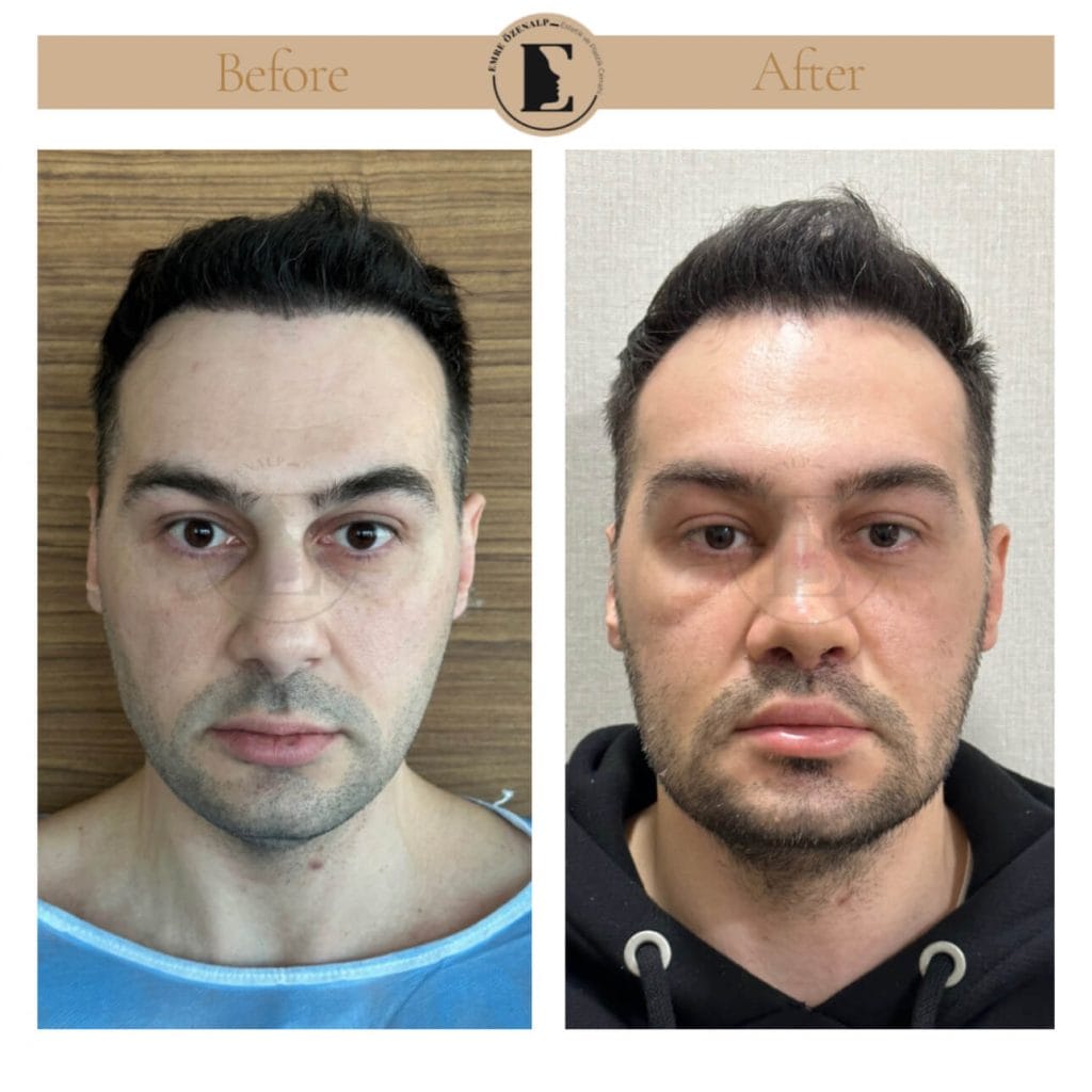 Lip lift surgery before after in Turkey results with experienced doctor Emre Özenalp. The patient has been done upper reshape lip lift surgery
