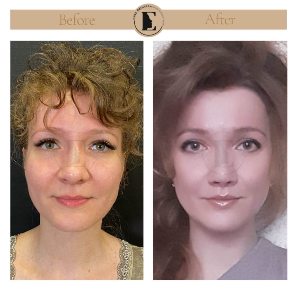 Lip lift surgery before after in Turkey results with experienced doctor Emre Özenalp. The patient has been done upper reshape lip lift surgery