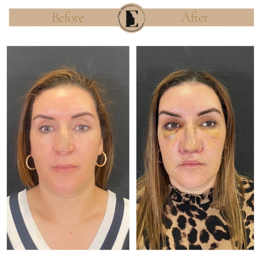 Lip lift surgery before after in Turkey results with experienced doctor Emre Özenalp. The patient has been done upper reshape lip lift surgery