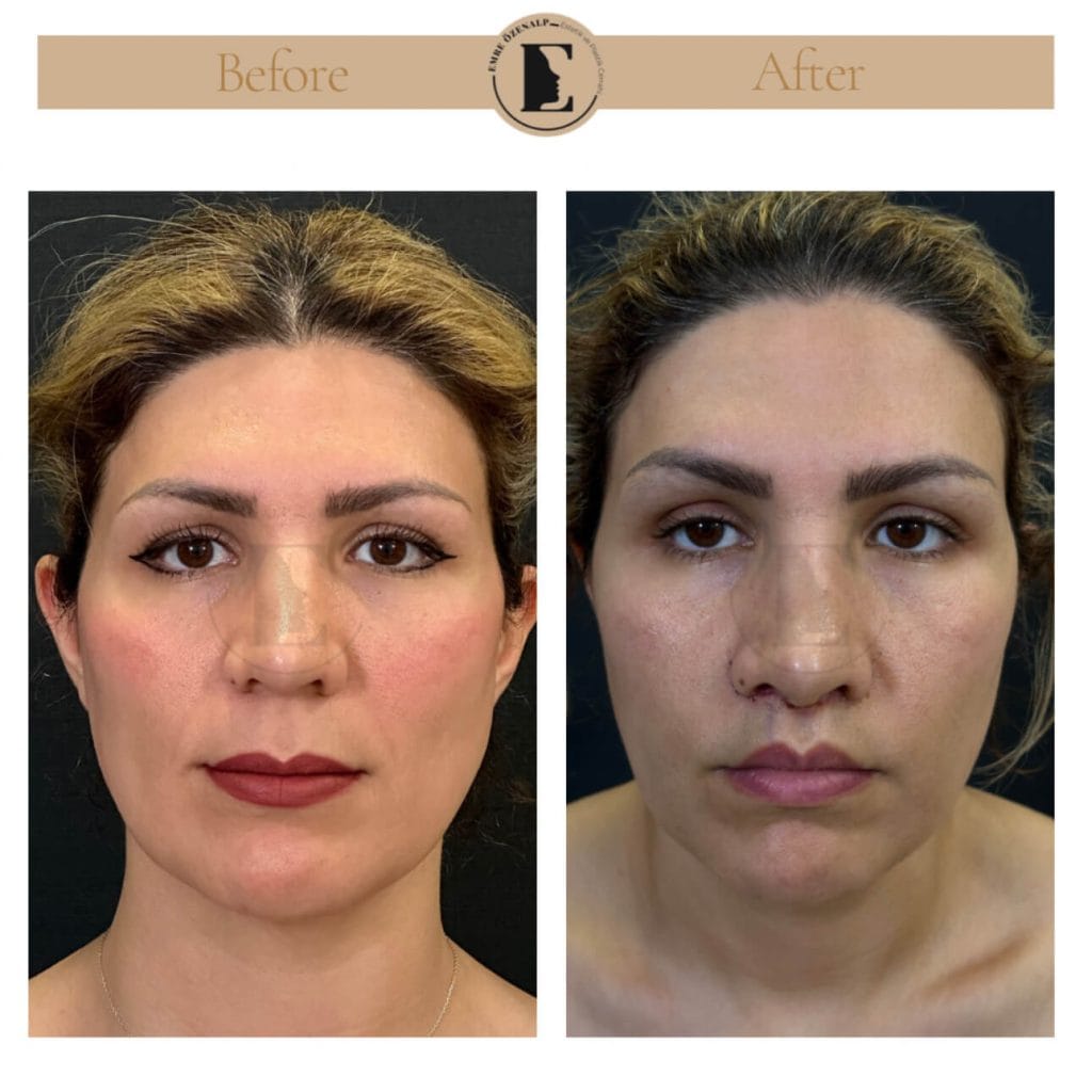 Lip lift surgery before after in Turkey results with experienced doctor Emre Özenalp. The patient has been done upper reshape lip lift surgery