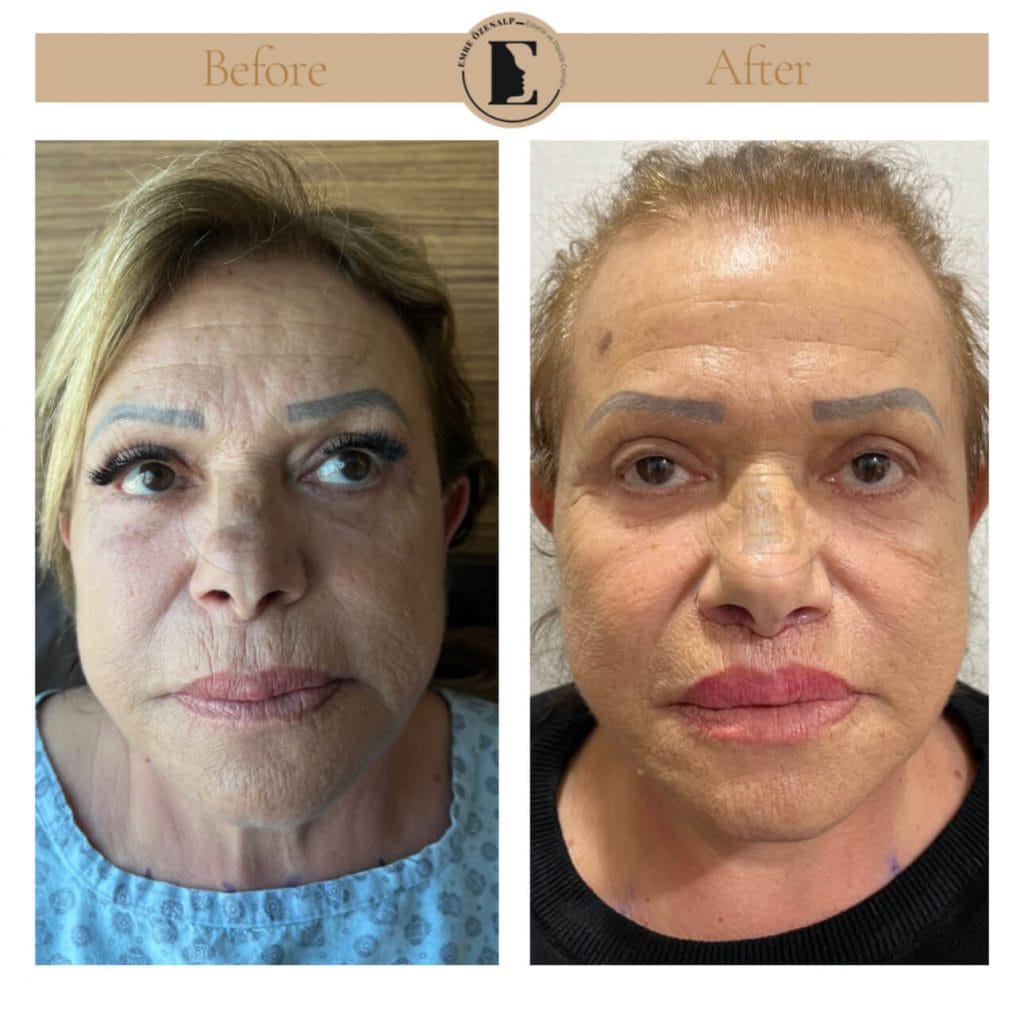 Lip lift surgery before after in Turkey results with experienced doctor Emre Özenalp. The patient has been done upper reshape lip lift surgery