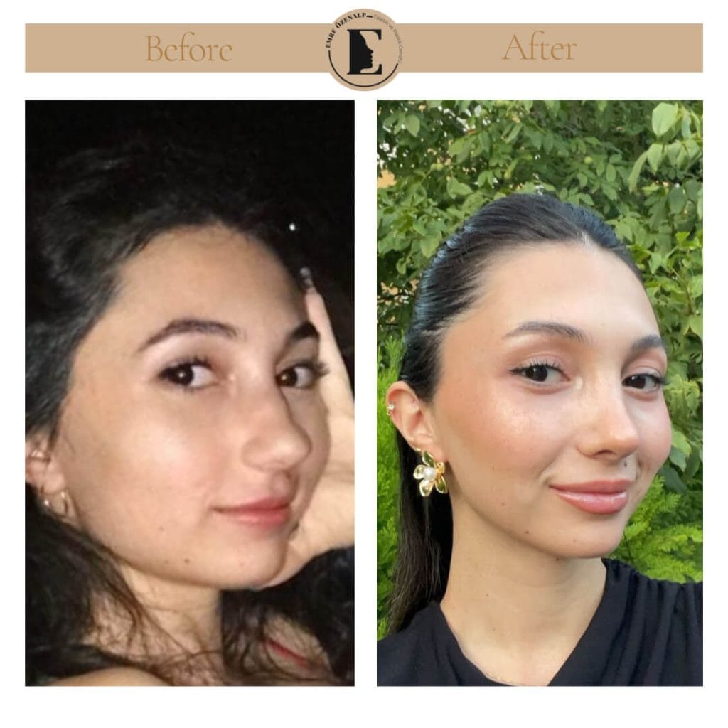 Nose job before after in Turkey results with experienced doctor Emre Özenalp. The patient has undergone rhinoplasty surgery.