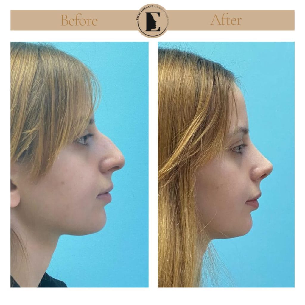 Nose job before after in Turkey results with experienced doctor Emre Özenalp. The patient has undergone rhinoplasty surgery.