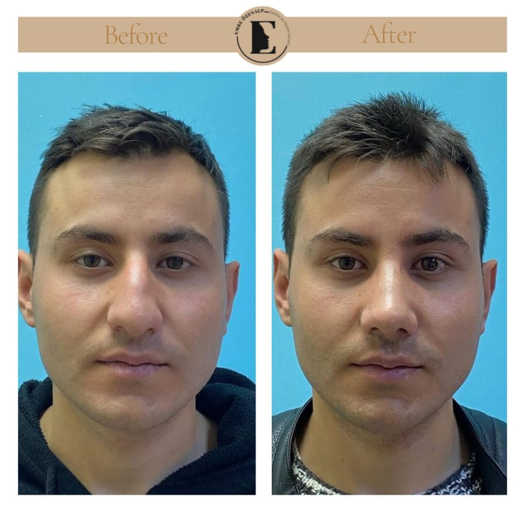 Nose job before after in Turkey results with experienced doctor Emre Özenalp. The patient has undergone rhinoplasty surgery.