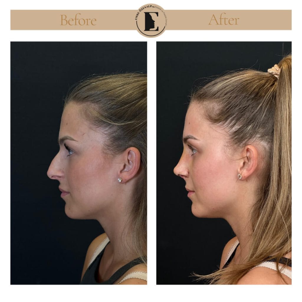 Nose job before after in Turkey results with experienced doctor Emre Özenalp. The patient has undergone rhinoplasty surgery.