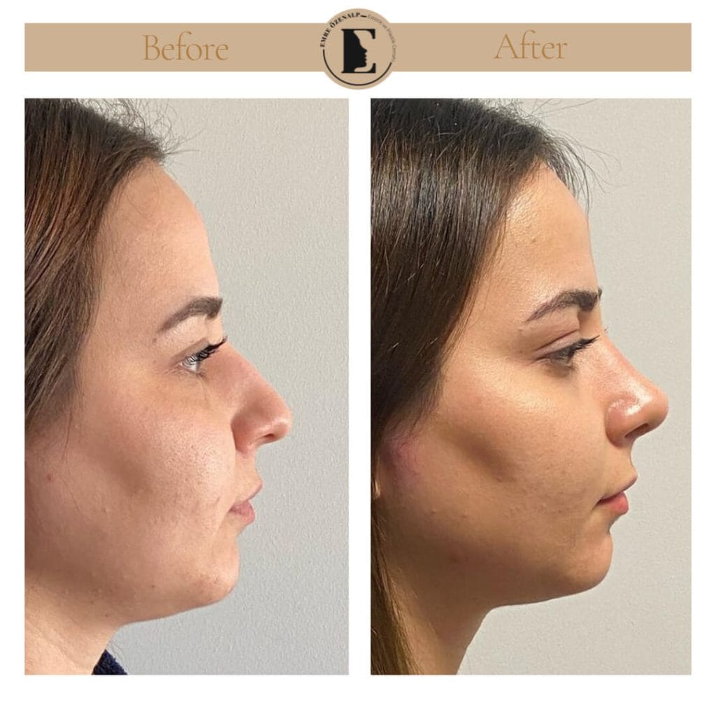 Nose job before after in Turkey results with experienced doctor Emre Özenalp. The patient has undergone rhinoplasty surgery.