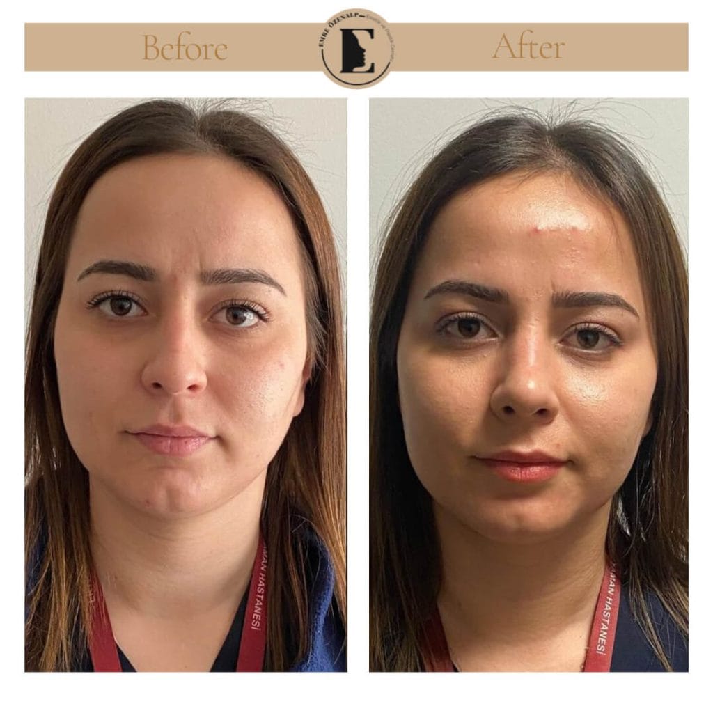 Nose job before after in Turkey results with experienced doctor Emre Özenalp. The patient has undergone rhinoplasty surgery.