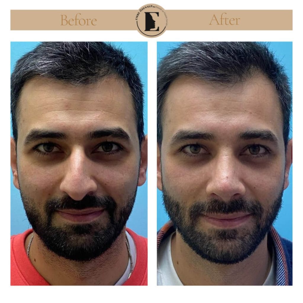 Nose job before after in Turkey results with experienced doctor Emre Özenalp. The patient has undergone rhinoplasty surgery.