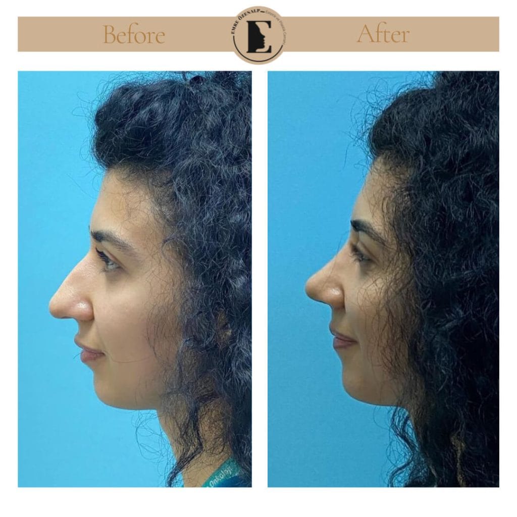 Nose job before after in Turkey results with experienced doctor Emre Özenalp. The patient has undergone rhinoplasty surgery.