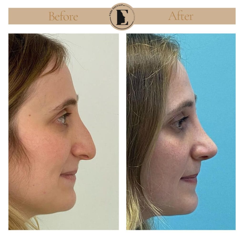 Nose job before after in Turkey results with experienced doctor Emre Özenalp. The patient has undergone rhinoplasty surgery.