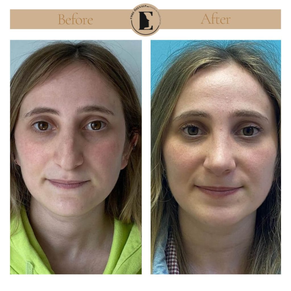 Nose job before after in Turkey results with experienced doctor Emre Özenalp. The patient has undergone rhinoplasty surgery.
