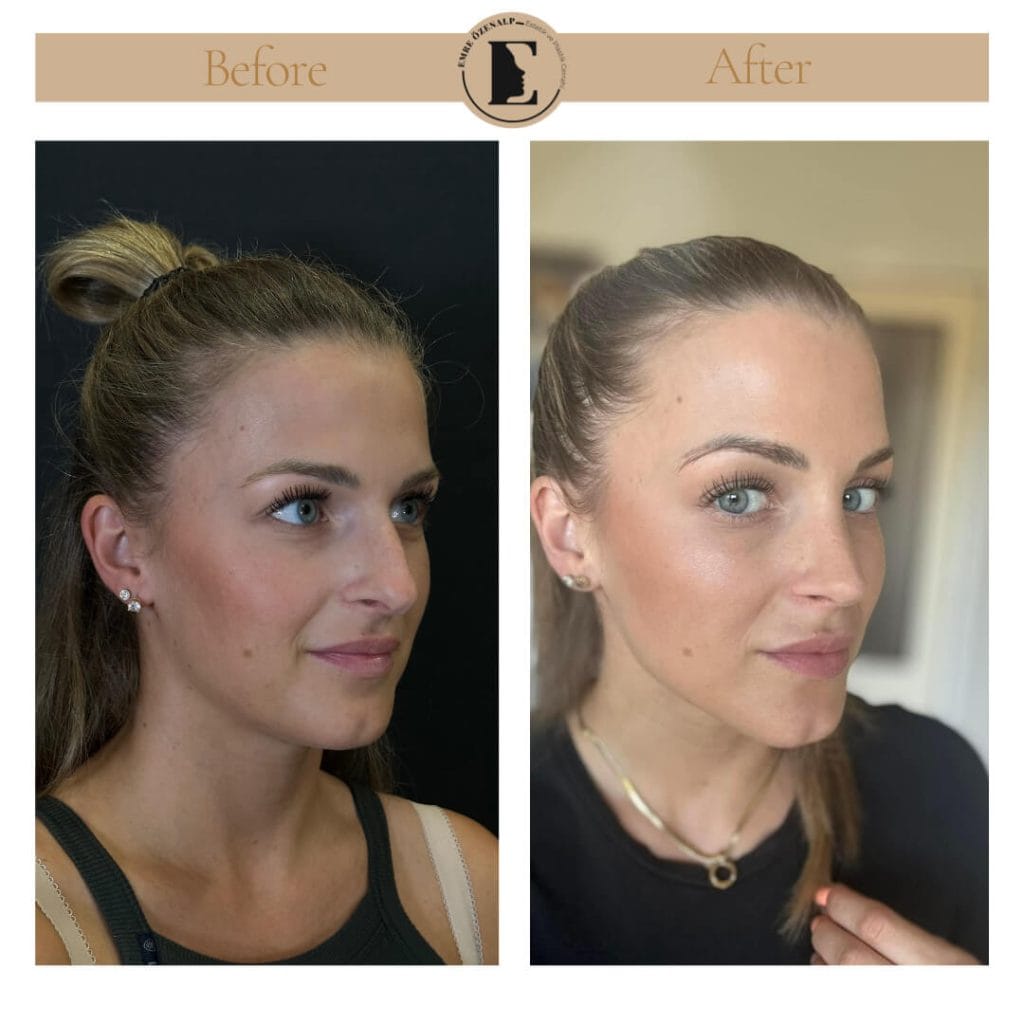 Nose job before after in Turkey results with experienced doctor Emre Özenalp. The patient has undergone rhinoplasty surgery.