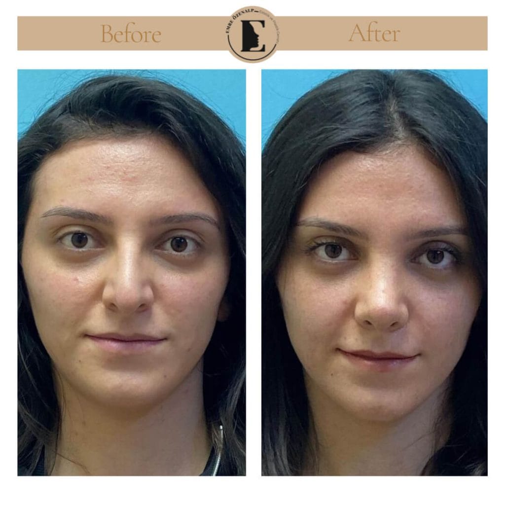 Nose job before after in Turkey results with experienced doctor Emre Özenalp. The patient has undergone rhinoplasty surgery.