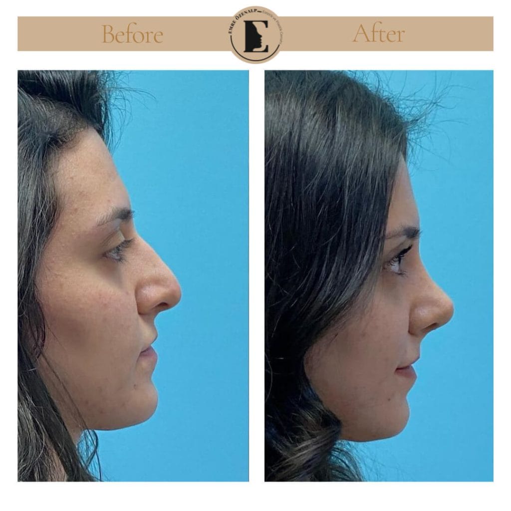 Nose job before after in Turkey results with experienced doctor Emre Özenalp. The patient has undergone rhinoplasty surgery.