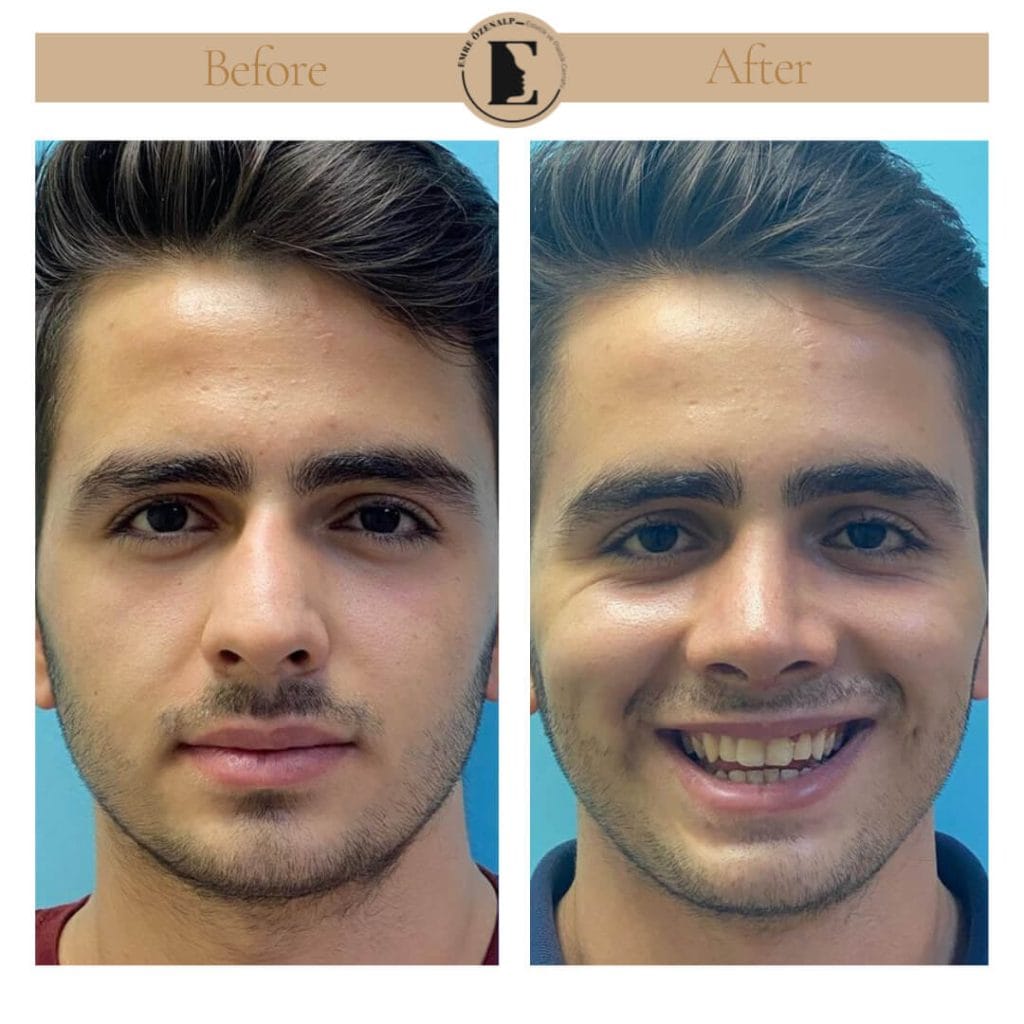 Nose job before after in Turkey results with experienced doctor Emre Özenalp. The patient has undergone rhinoplasty surgery.