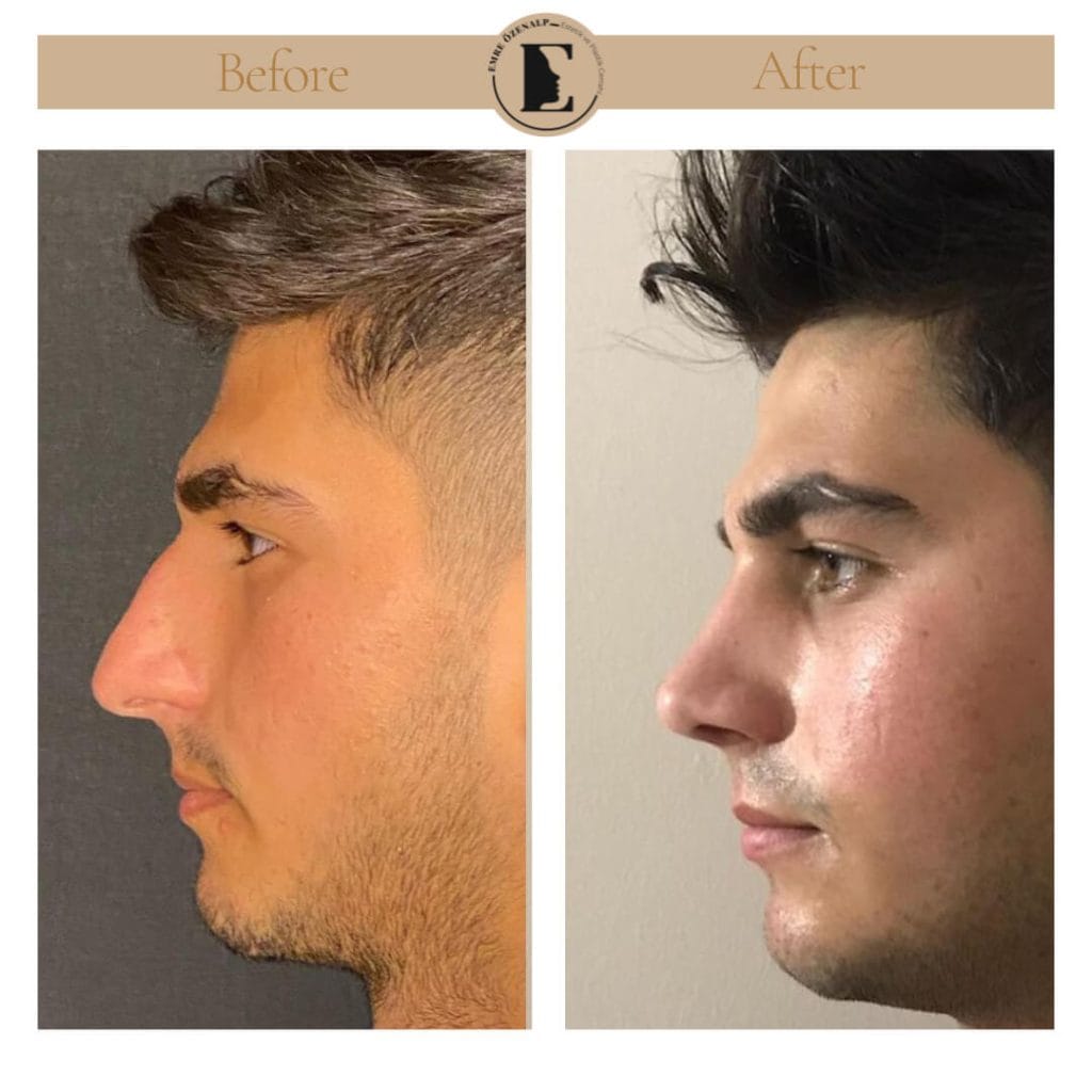 Nose job before after in Turkey results with experienced doctor Emre Özenalp. The patient has undergone rhinoplasty surgery.