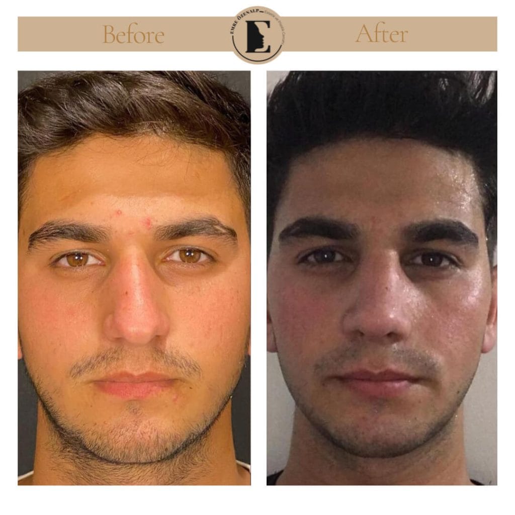 Nose job before after in Turkey results with experienced doctor Emre Özenalp. The patient has undergone rhinoplasty surgery.