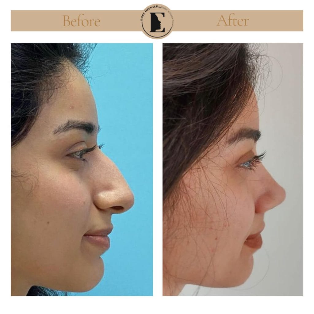 Nose job before after in Turkey results with experienced doctor Emre Özenalp. The patient has undergone rhinoplasty surgery.