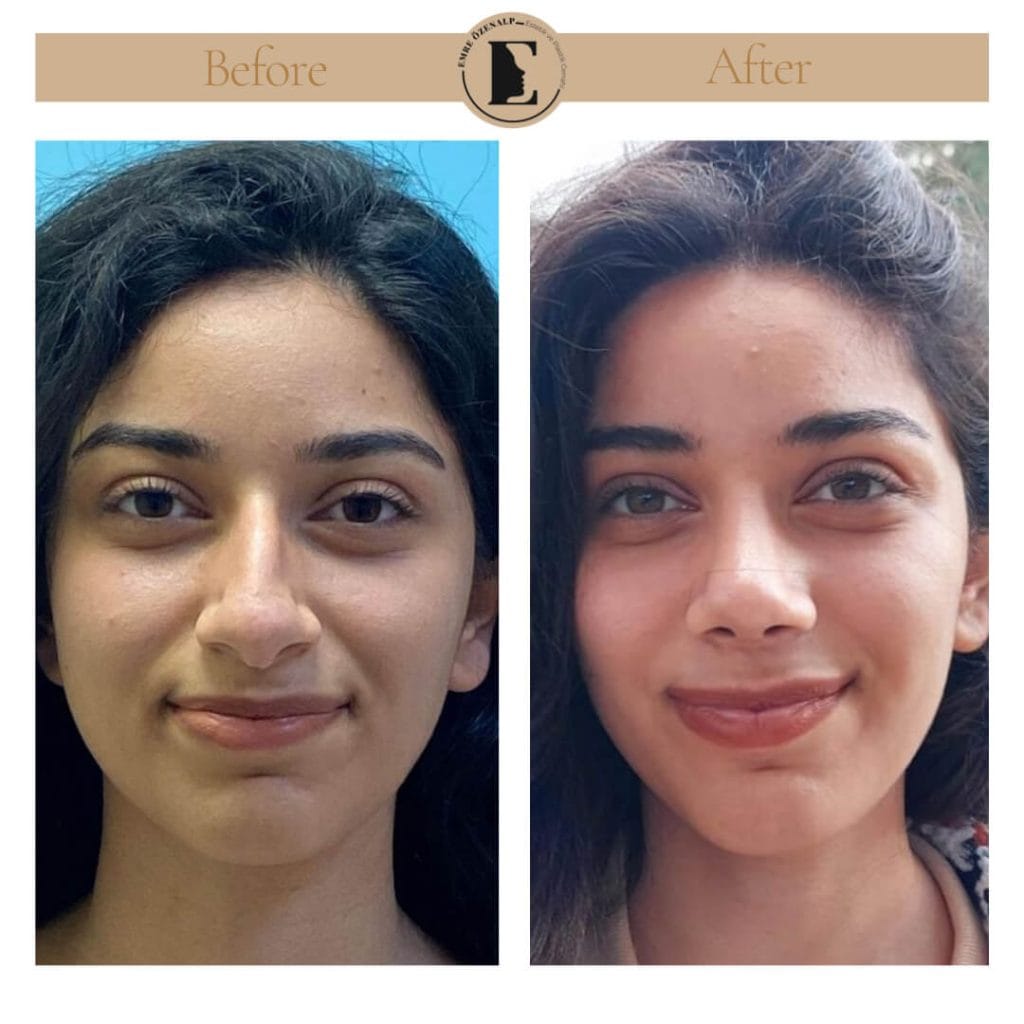 Nose job before after in Turkey results with experienced doctor Emre Özenalp. The patient has undergone rhinoplasty surgery.