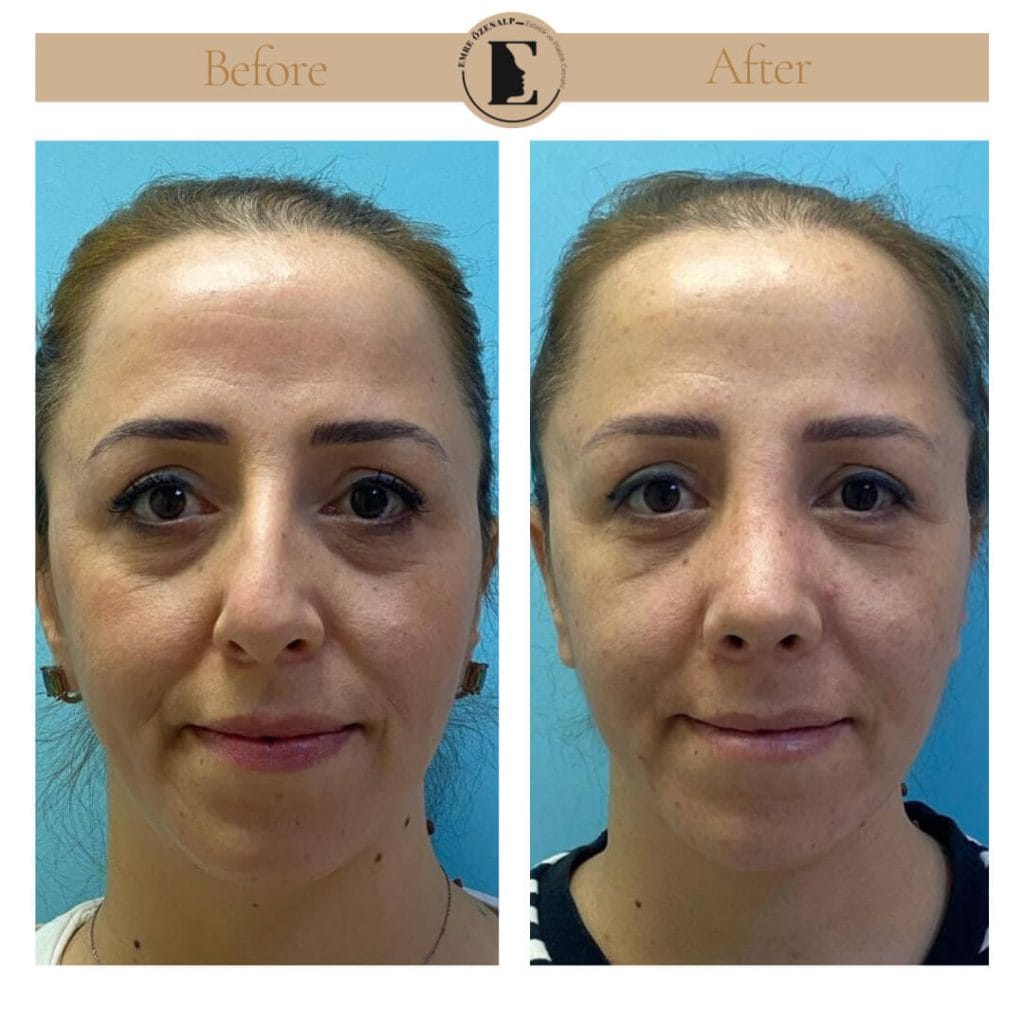 Nose job before after in Turkey results with experienced doctor Emre Özenalp. The patient has undergone rhinoplasty surgery.