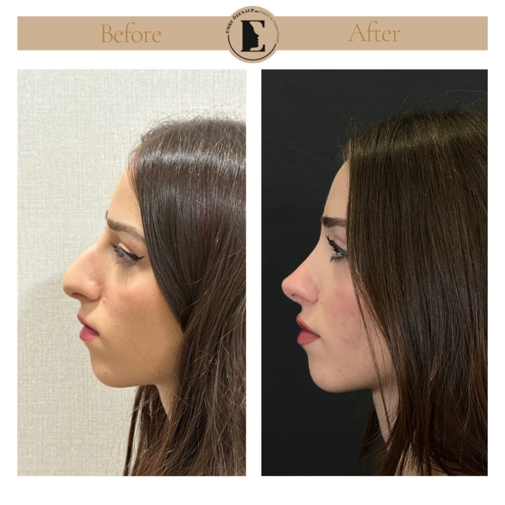 Nose job before after in Turkey results with experienced doctor Emre Özenalp. The patient has undergone rhinoplasty surgery.