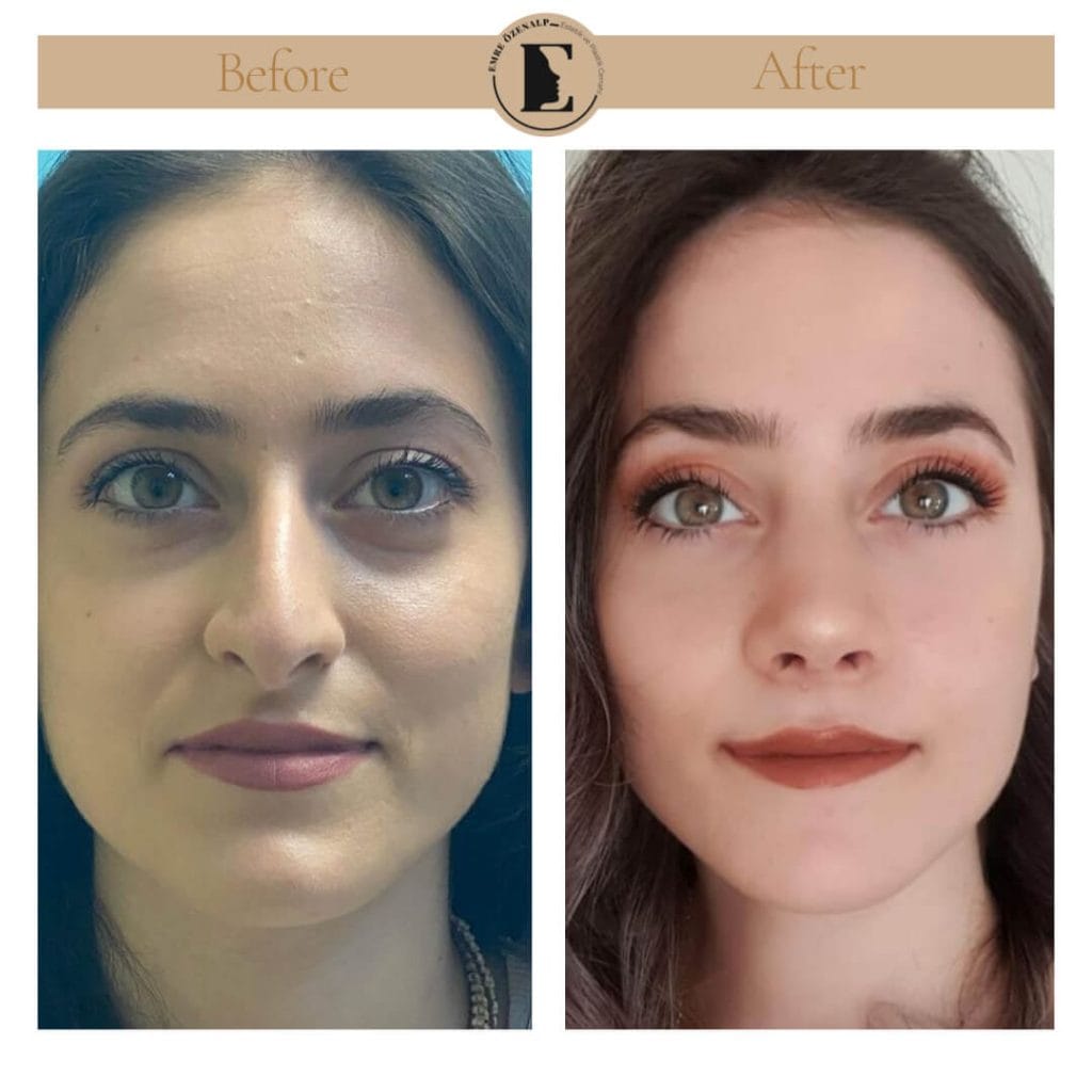 Nose job before after in Turkey results with experienced doctor Emre Özenalp. The patient has undergone rhinoplasty surgery.