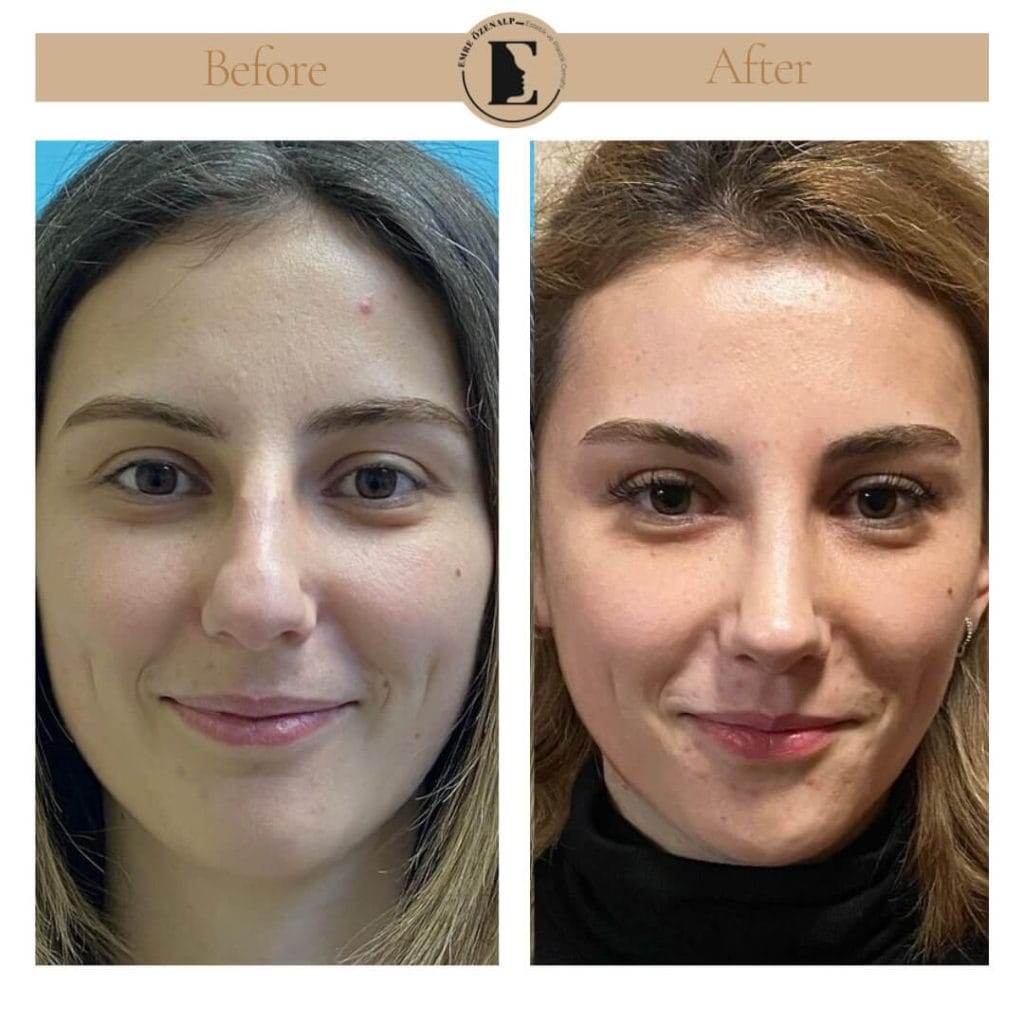 Nose job before after in Turkey results with experienced doctor Emre Özenalp. The patient has undergone rhinoplasty surgery.