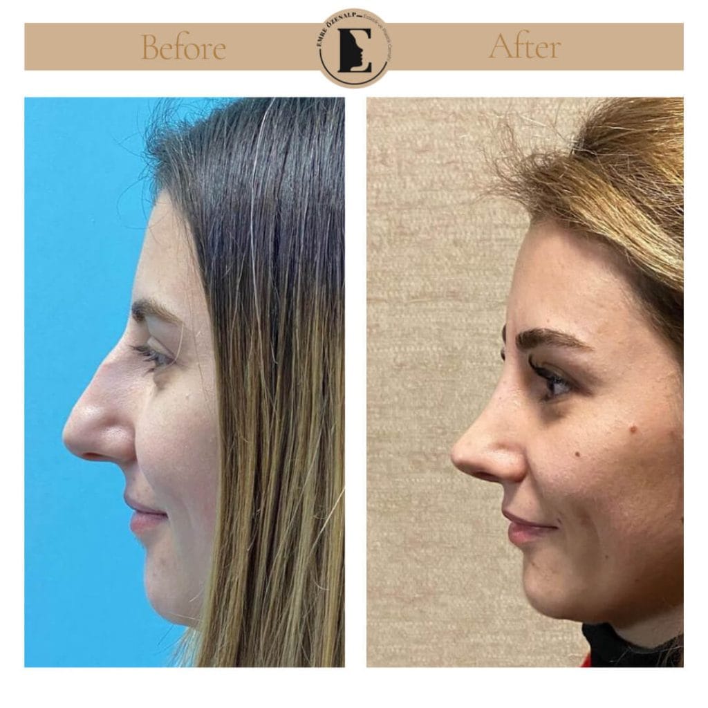 Nose job before after in Turkey results with experienced doctor Emre Özenalp. The patient has undergone rhinoplasty surgery.