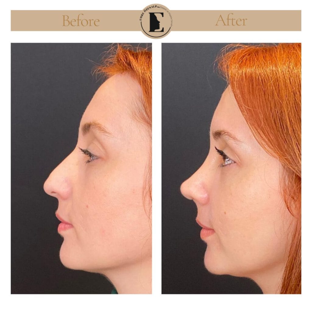 Nose job before after in Turkey results with experienced doctor Emre Özenalp. The patient has undergone rhinoplasty surgery.