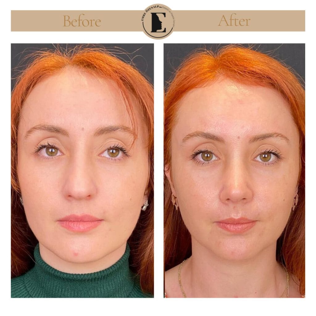 Nose job before after in Turkey results with experienced doctor Emre Özenalp. The patient has undergone rhinoplasty surgery.