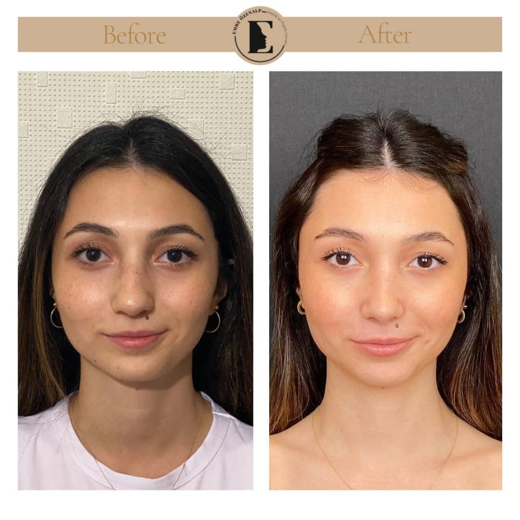 Nose job before after in Turkey results with experienced doctor Emre Özenalp. The patient has undergone rhinoplasty surgery.