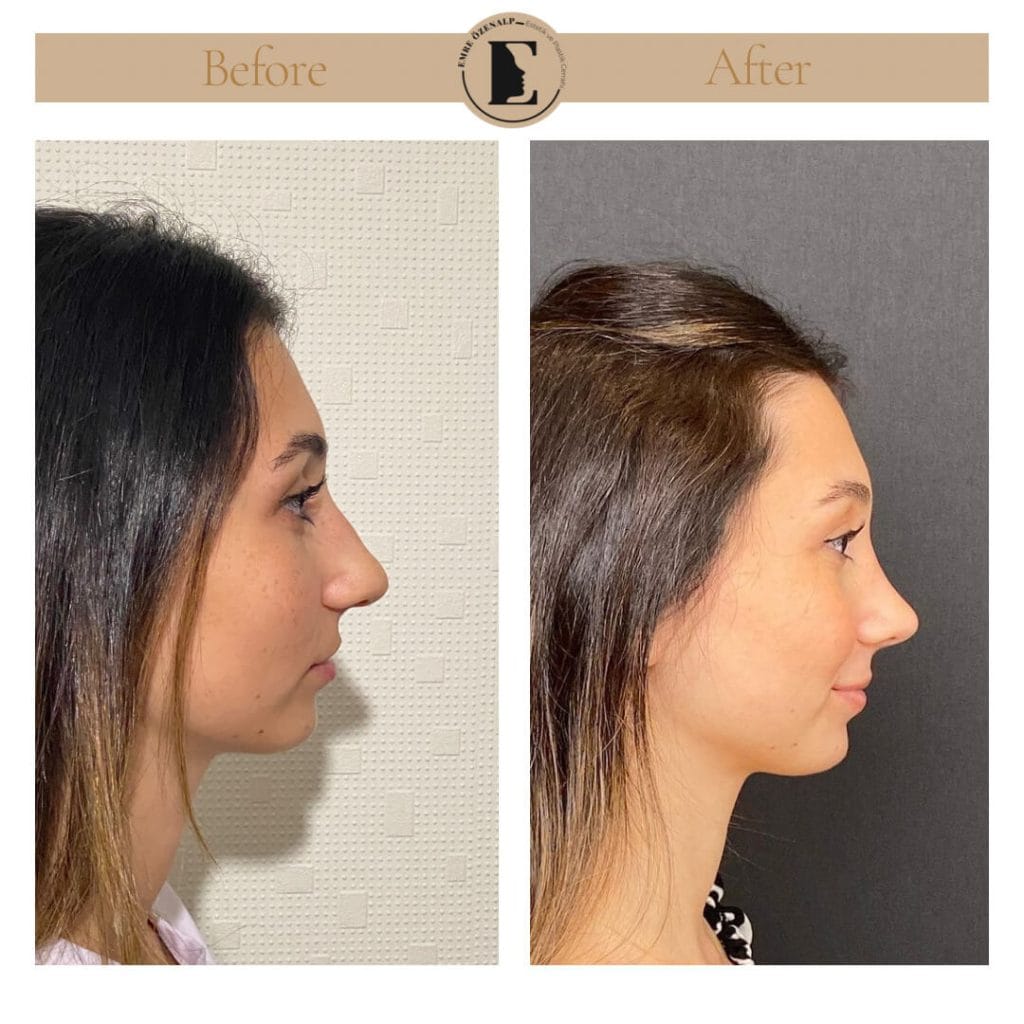 Nose job before after in Turkey results with experienced doctor Emre Özenalp. The patient has undergone rhinoplasty surgery.