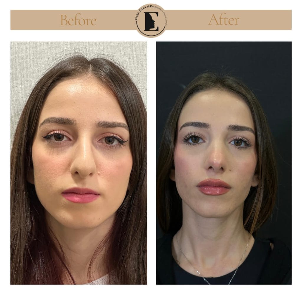 Nose job before after in Turkey results with experienced doctor Emre Özenalp. The patient has undergone rhinoplasty surgery.