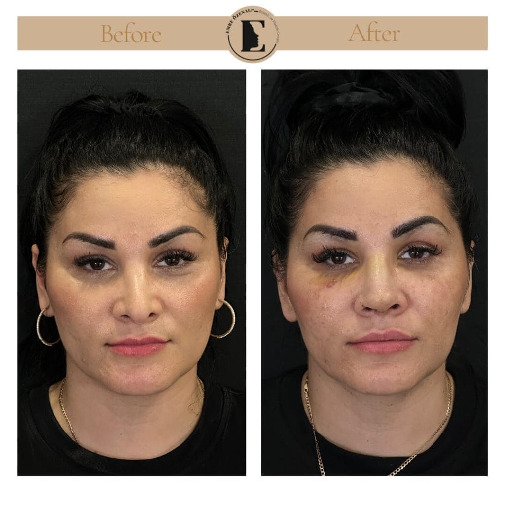 Nose job before after in Turkey results with experienced doctor Emre Özenalp. The patient has undergone rhinoplasty surgery.