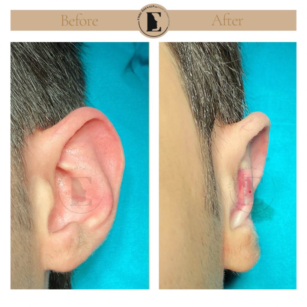 Otoplasty (prominent ear surgery) before after in Turkey results with experienced doctor Emre Özenalp. The patient has been done otoplasty surgery.
