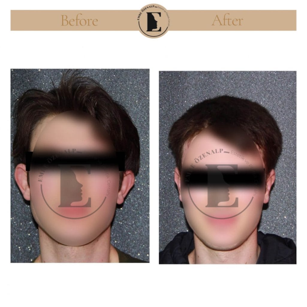 Otoplasty (prominent ear surgery) before after in Turkey results with experienced doctor Emre Özenalp. The patient has been done otoplasty surgery.