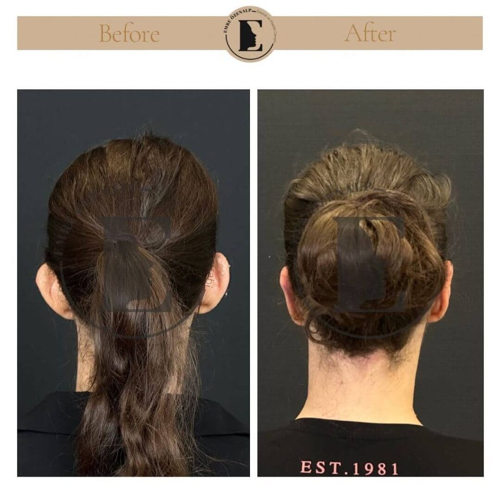 Otoplasty (prominent ear surgery) before after in Turkey results with experienced doctor Emre Özenalp. The patient has been done otoplasty surgery.